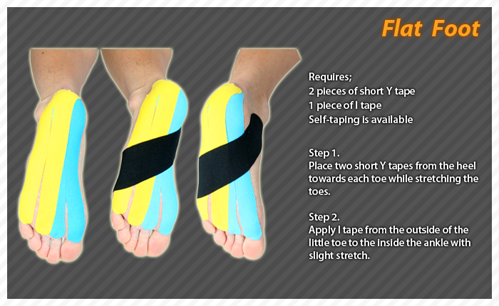 Flat Feet