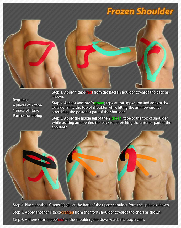 ares clinical taping-frozenshoulder