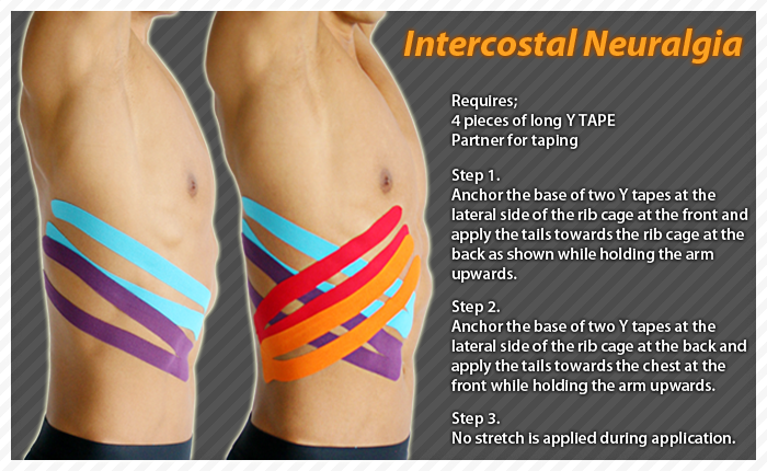 ares clinical taping - intercostal neuralgia