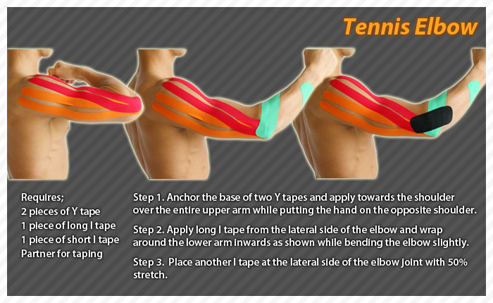 ares clinical taping - tennis elbow