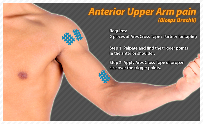 ares clinical taping - bruise