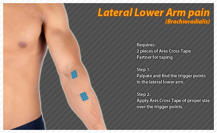 ares clinical taping - bruise