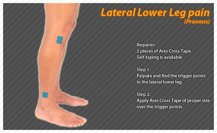 ares clinical taping - bruise