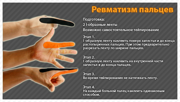 Схема тейпирования запястья при боли